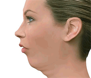 Retrognatia-mandibular-ClaseII-cirugia ortognatica cordoba