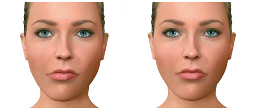 asimetría facial cirugia ortognatica cordoba dr candau