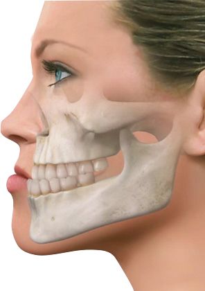 cirugia-Ortognatica-prognatismo-clase-3