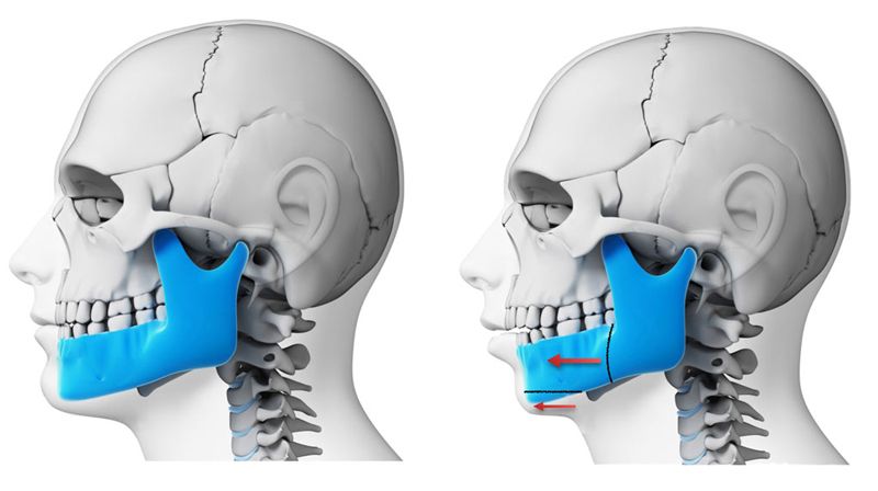 cirugia-ortognatica-cordoba-dr-candau-maxilofacial