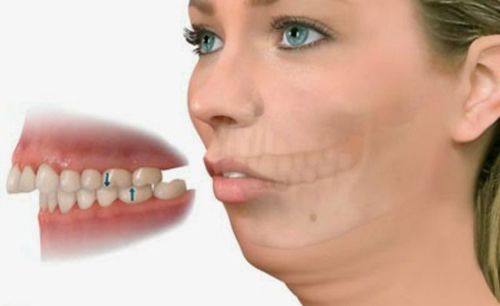 cirugia-ortognatica-de-clase-ii-retrognatia-cordoba