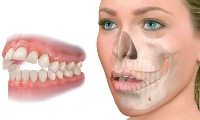 mordida-abierta-cirugia-ortognatica-dr-alberto-candau-maxilofacial-cordoba