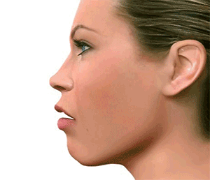 mordida-abierta-cirugia-ortognatica dr candau maxilofacial