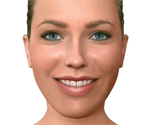 mordida-abierta-cirugia-ortognatica-dr-alberto-candau-maxilofacial-cordoba